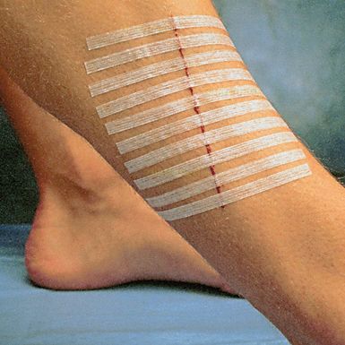 Pansement Steri-Strip 38x6 mm : pansement suture pour cicatrisation d'une  plaie